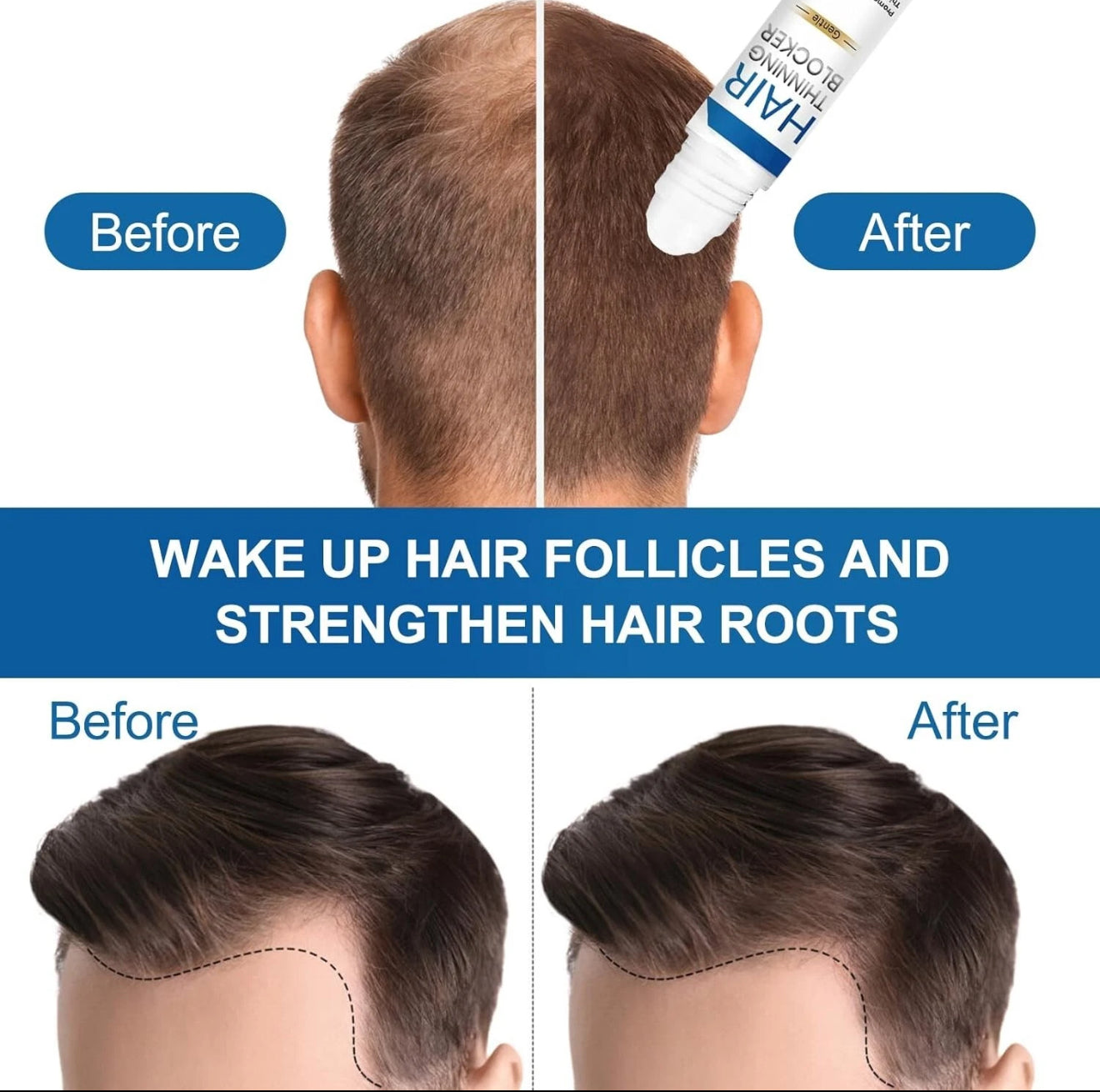 Genthair DHT ππ₯π¨ππ€ππ« for Men, Genthair Hair Growth Roller, Genthair DHT ππ₯π¨ππ€ππ« Roll On for Men, Gent Hair DHT Blocker.