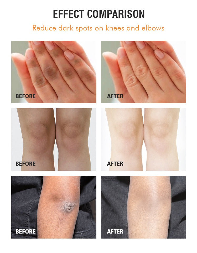 Dark Knuckle Remover Underarm Cream Body Moisturizer Lotion Dark Toe Knuckles Treatment Removal Remover Corrector 4.21floz/120g