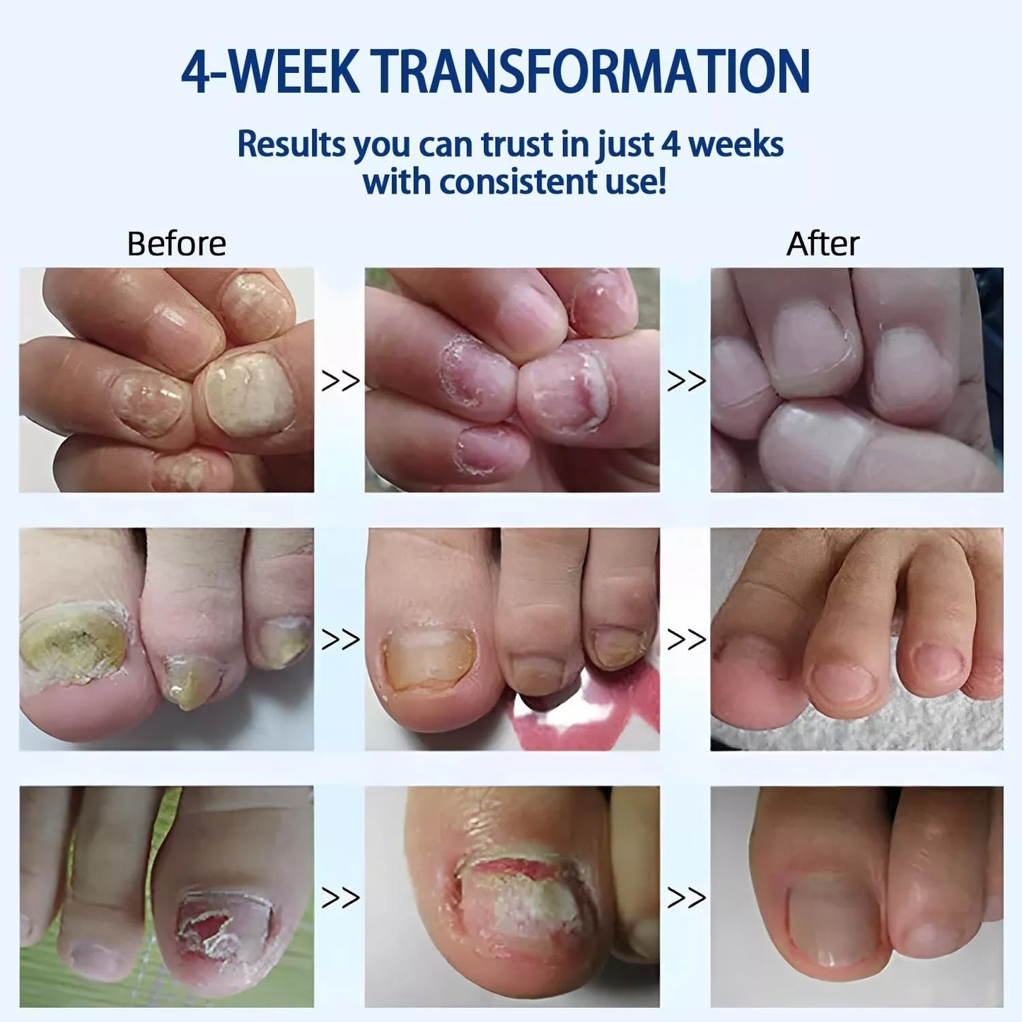 Natural Plant Drops for Nails Care Tea Tree and Oregano Oil fo Toenail Nail Care