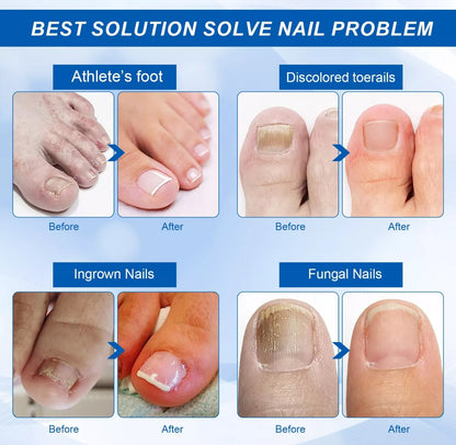 7-Day Toenail Fungus Treatment oil Anti Paronychia Relief Oil,Bunion Therapy