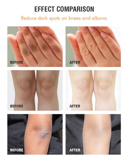 Dark Knuckle Remover Underarm Cream Body Moisturizer Lotion Dark Toe Knuckles Treatment Removal Remover Corrector 4.21floz/120g